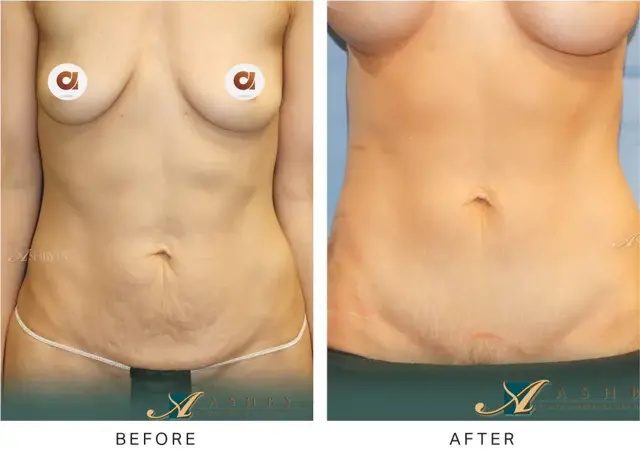 Mommy Makeover result at Ashby Plastic Surgery & Aesthetics: Eric R Ashby MD in Layton, UT