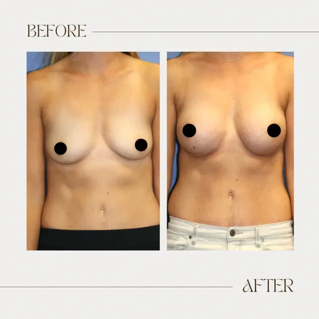 Breast Augmentation result at Ashby Plastic Surgery & Aesthetics: Eric R Ashby MD in Layton, UT