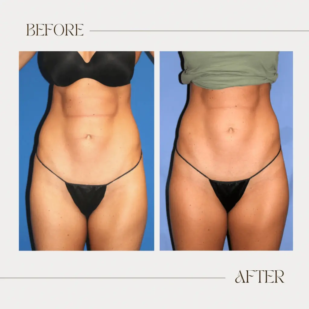 Ashby Plastic Surgery & Aesthetics: Eric R Ashby MD liposuction result — Layton, UT