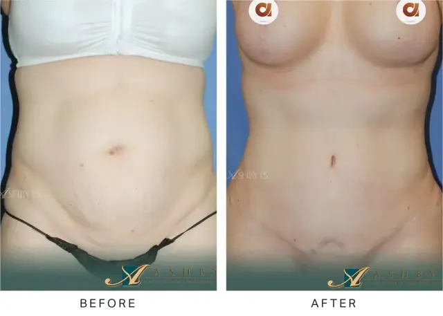 Mini Tummy Tuck result at Ashby Plastic Surgery & Aesthetics: Eric R Ashby MD in Layton, UT