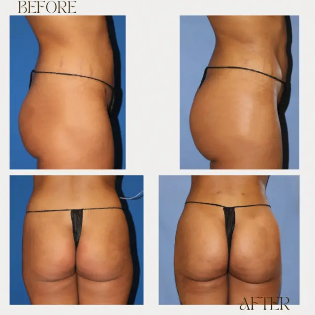 Brazilian Butt Lift result at Ashby Plastic Surgery & Aesthetics: Eric R Ashby MD in Layton, UT