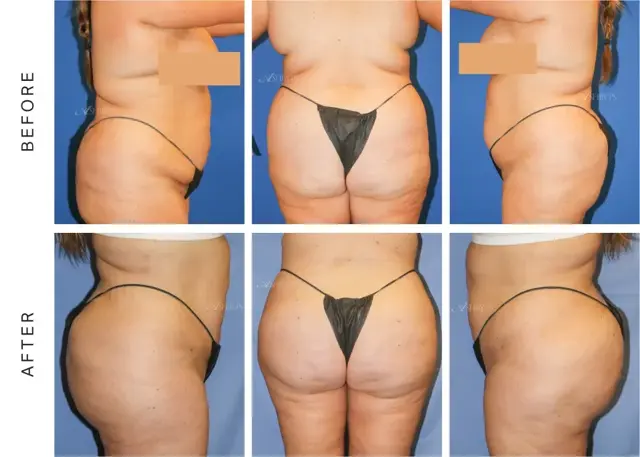 Brazilian Butt Lift result at Ashby Plastic Surgery & Aesthetics: Eric R Ashby MD in Layton, UT