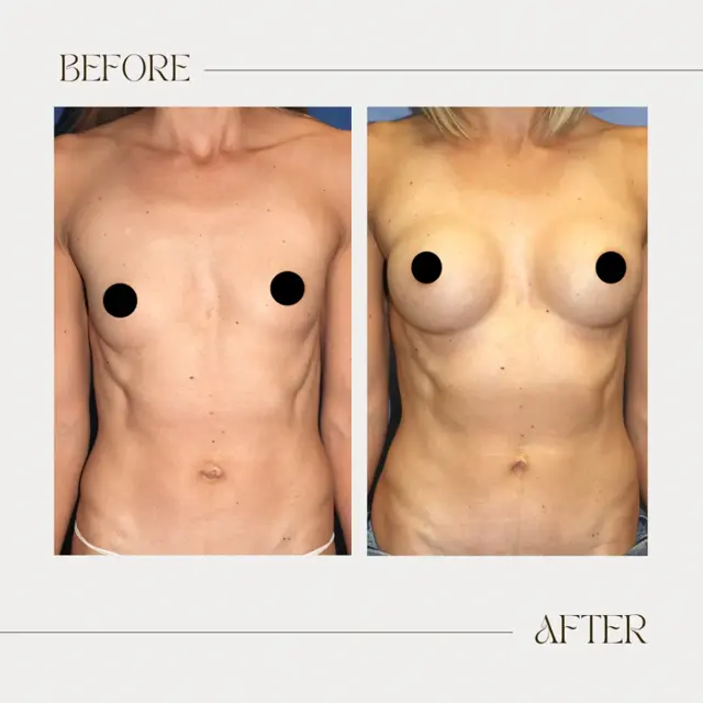Breast Augmentation result at Ashby Plastic Surgery & Aesthetics: Eric R Ashby MD in Layton, UT