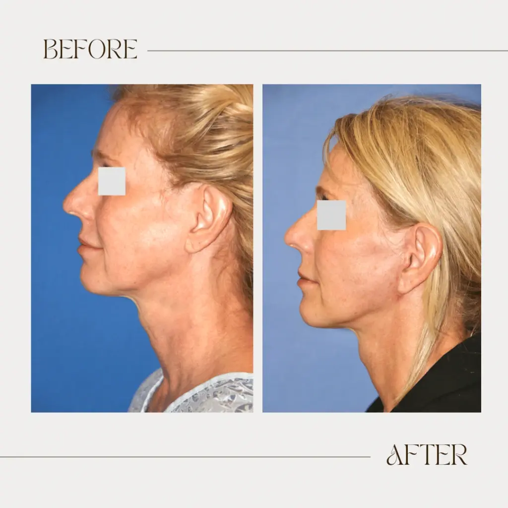 Ashby Plastic Surgery & Aesthetics: Eric R Ashby MD facelift result — Layton, UT