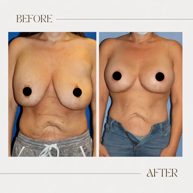 Breast Lift result at Ashby Plastic Surgery & Aesthetics: Eric R Ashby MD in Layton, UT