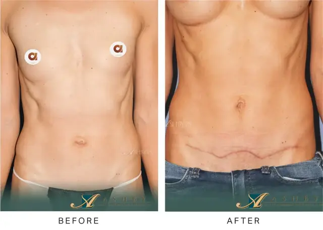 Mommy Makeover result at Ashby Plastic Surgery & Aesthetics: Eric R Ashby MD in Layton, UT