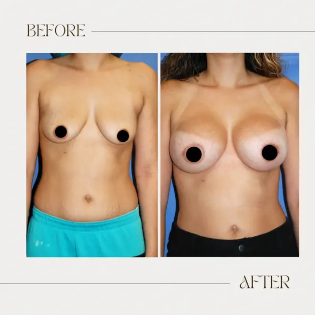 Breast Augmentation result at Ashby Plastic Surgery & Aesthetics: Eric R Ashby MD in Layton, UT