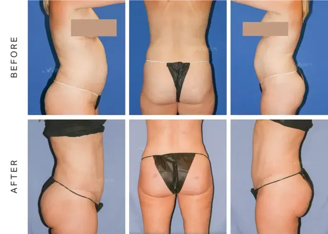 Brazilian Butt Lift result at Ashby Plastic Surgery & Aesthetics: Eric R Ashby MD in Layton, UT