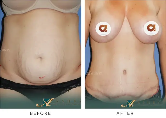 Mommy Makeover result at Ashby Plastic Surgery & Aesthetics: Eric R Ashby MD in Layton, UT