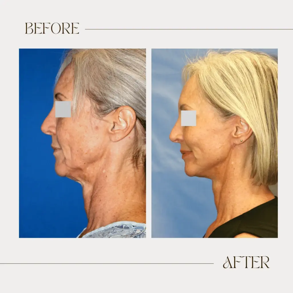 Ashby Plastic Surgery & Aesthetics: Eric R Ashby MD facelift result — Layton, UT