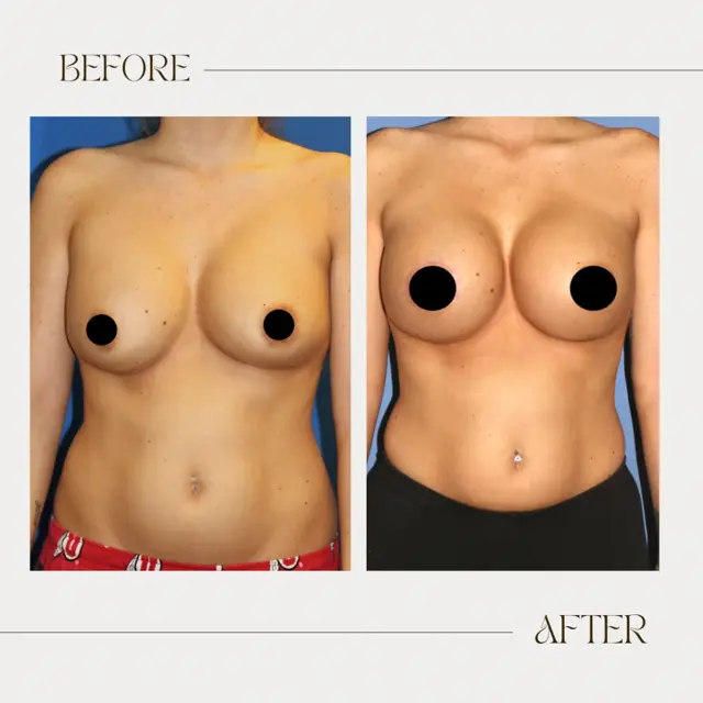 Breast Augmentation result at Ashby Plastic Surgery & Aesthetics: Eric R Ashby MD in Layton, UT