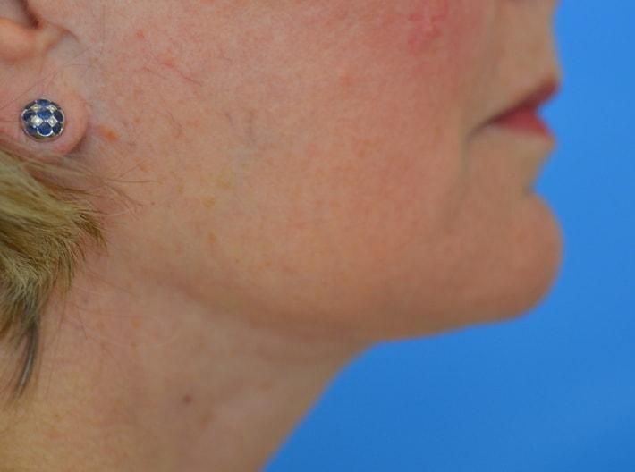 Ramsey Alsarraf, MD facelift after — Boston, MA