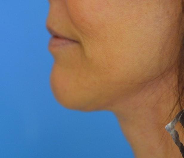 Ramsey Alsarraf, MD facelift after — Boston, MA