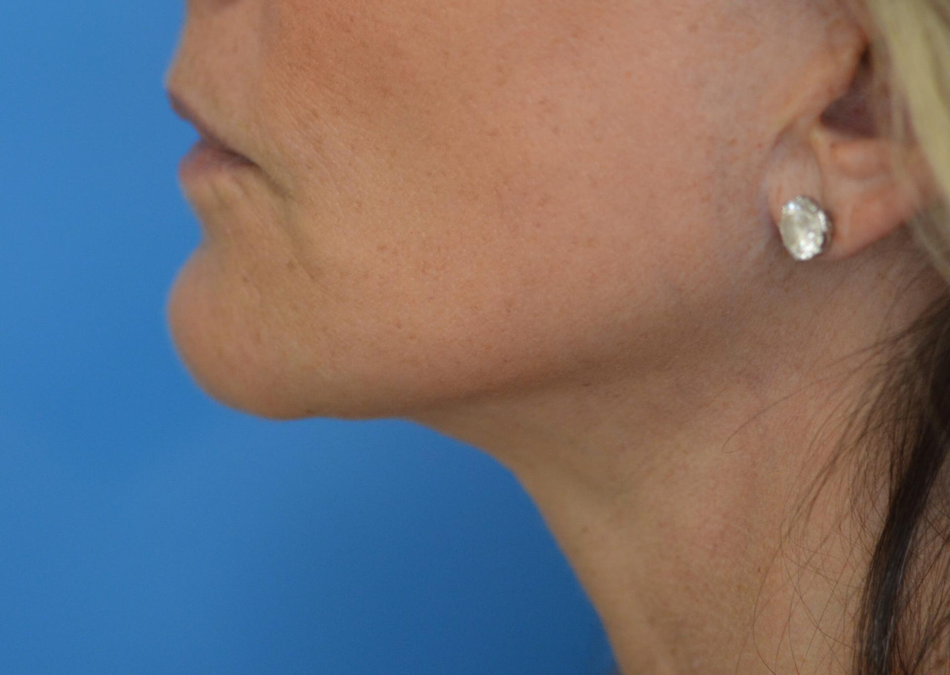 Ramsey Alsarraf, MD facelift after — Boston, MA