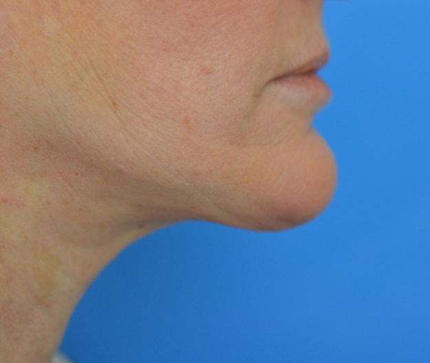 Ramsey Alsarraf, MD facelift after — Boston, MA