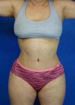 Ilumaforma Aesthetic Surgery tummy tuck after — Downers Grove, IL