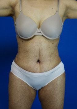 Ilumaforma Aesthetic Surgery tummy tuck after — Downers Grove, IL