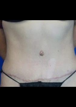 Ilumaforma Aesthetic Surgery tummy tuck after — Downers Grove, IL