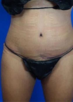 Ilumaforma Aesthetic Surgery tummy tuck after — Downers Grove, IL