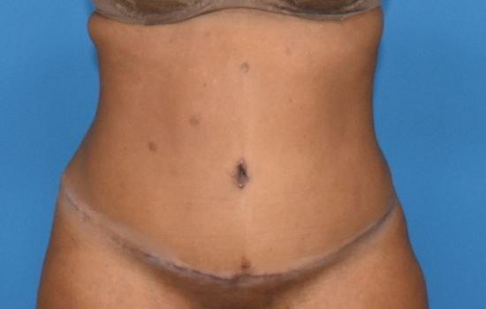 Amy K. Alderman, MD tummy tuck after — Alpharetta, GA