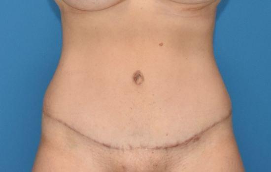 Amy K. Alderman, MD tummy tuck after — Alpharetta, GA