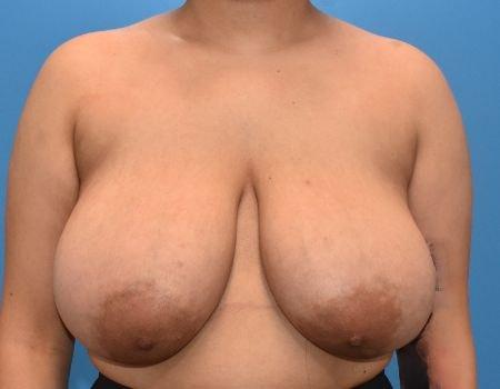 Breast Reduction before at Amy K. Alderman, MD in Alpharetta, GA