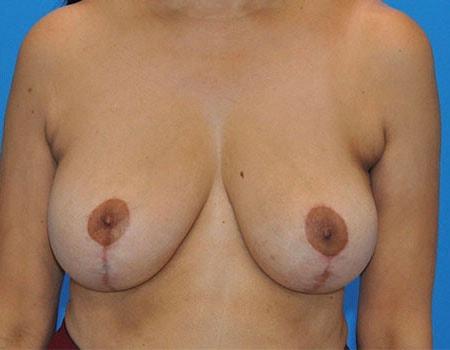 Amy K. Alderman, MD breast reduction after — Alpharetta, GA