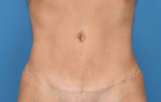 Amy K. Alderman, MD tummy tuck after — Alpharetta, GA