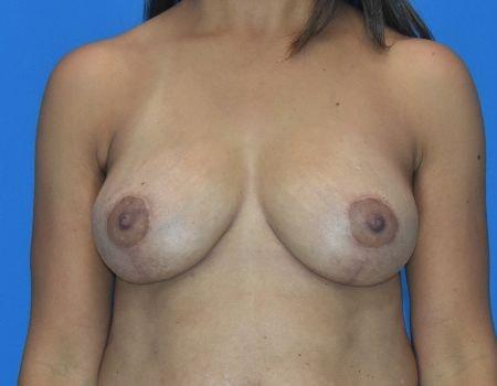 Amy K. Alderman, MD breast reduction after — Alpharetta, GA