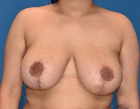 Breast Reduction after at Amy K. Alderman, MD in Alpharetta, GA