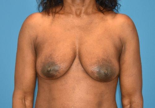 Fat Transfer Breast Augmentation before at Amy K. Alderman, MD in Alpharetta, GA