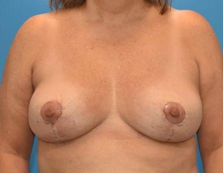 Amy K. Alderman, MD breast reduction after — Alpharetta, GA