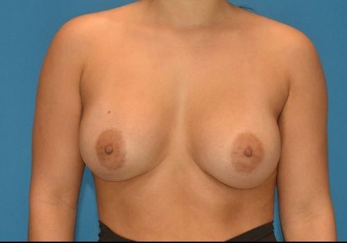 Amy K. Alderman, MD breast augmentation after — Alpharetta, GA