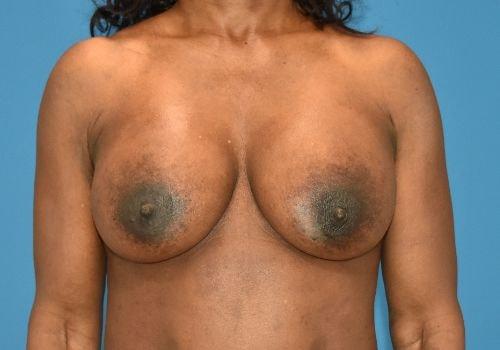 Amy K. Alderman, MD breast augmentation after — Alpharetta, GA