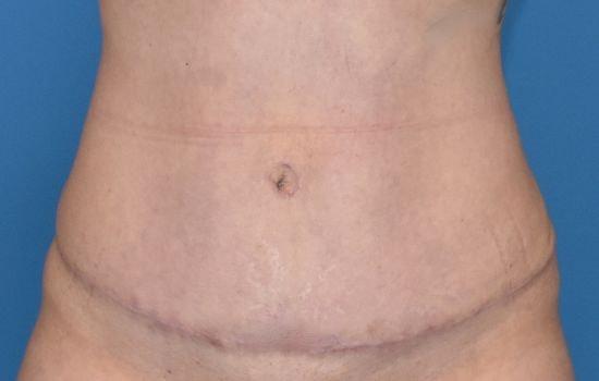 Amy K. Alderman, MD tummy tuck after — Alpharetta, GA