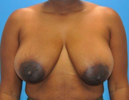 Breast Lift before at Amy K. Alderman, MD in Alpharetta, GA