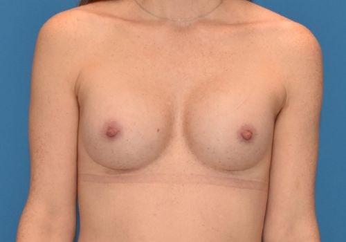 Amy K. Alderman, MD breast augmentation after — Alpharetta, GA