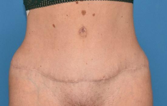Amy K. Alderman, MD tummy tuck after — Alpharetta, GA