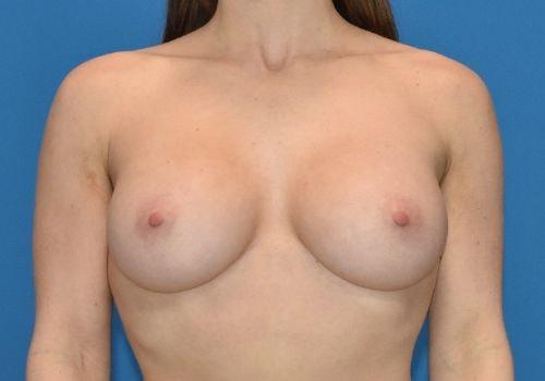 Amy K. Alderman, MD breast augmentation after — Alpharetta, GA