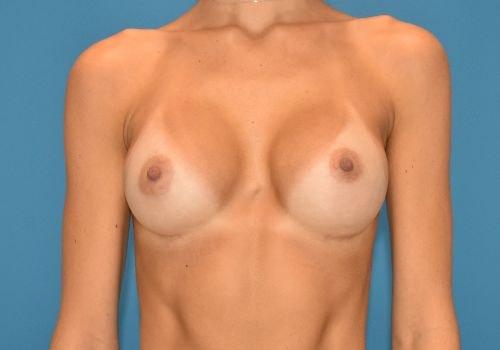 Amy K. Alderman, MD breast augmentation after — Alpharetta, GA