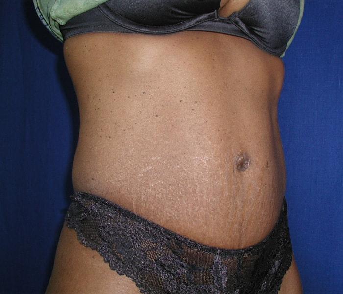 The Nikolov Center for Plastic Surgery (Nicholas Nikolov, MD) tummy tuck after — Beverly Hills, CA