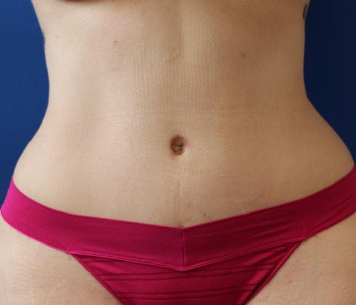 The Nikolov Center for Plastic Surgery (Nicholas Nikolov, MD) tummy tuck after — Beverly Hills, CA