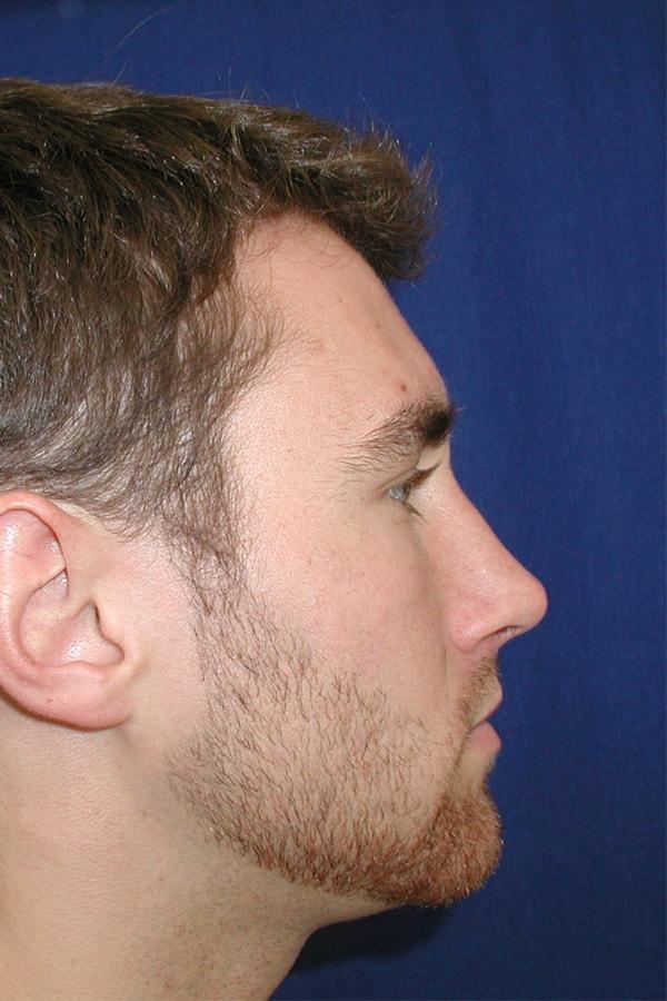 The Nikolov Center for Plastic Surgery (Nicholas Nikolov, MD) rhinoplasty after — Beverly Hills, CA