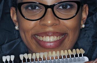 Smile Makeover before at Smile Lab Dallas | Dr. Parihan Tamkin, DDS in Dallas, TX