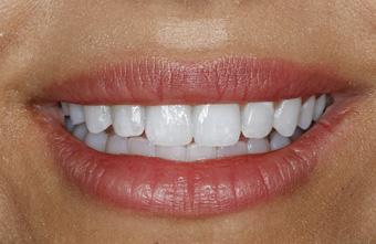 Smile Lab Dallas | Dr. Parihan Tamkin, DDS smile makeover after — Dallas, TX