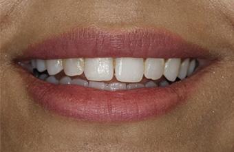 Smile Makeover before at Smile Lab Dallas | Dr. Parihan Tamkin, DDS in Dallas, TX