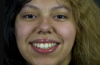 Smile Lab Dallas | Dr. Parihan Tamkin, DDS smile makeover after — Dallas, TX