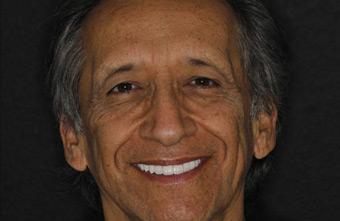 Smile Lab Dallas | Dr. Parihan Tamkin, DDS smile makeover after — Dallas, TX