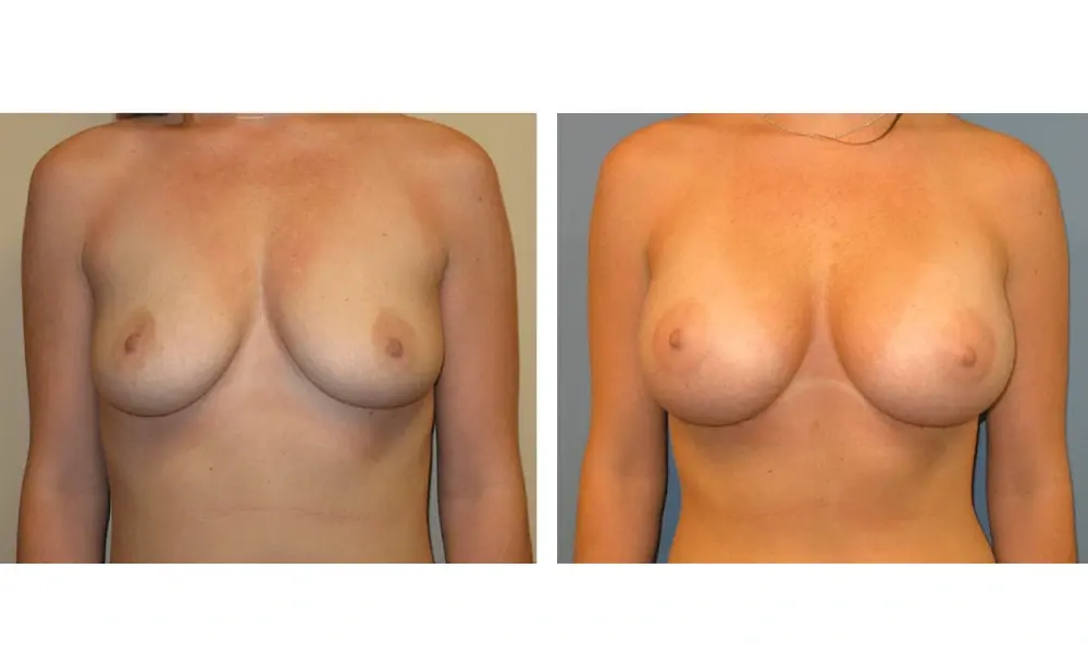 The Plastic Surgeon (Hall) breast augmentation result — Scottsdale, AZ