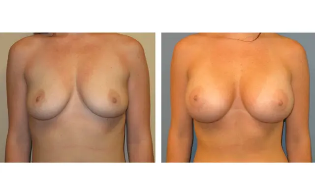 Breast Augmentation result at The Plastic Surgeon (Hall) in Scottsdale, AZ